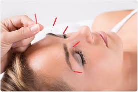 Akupunkturla Migren Tedavisi